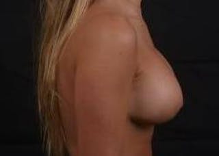Breast Augmentation Mastopexy Before & After Gallery - Patient 216324 - Image 6