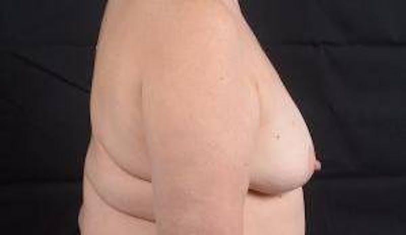 Immediate Breast Reconstruction – Skin Sparing Before & After Gallery - Patient 381662 - Image 5