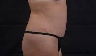 Abdominoplasty Before & After Gallery - Patient 196513 - Image 6