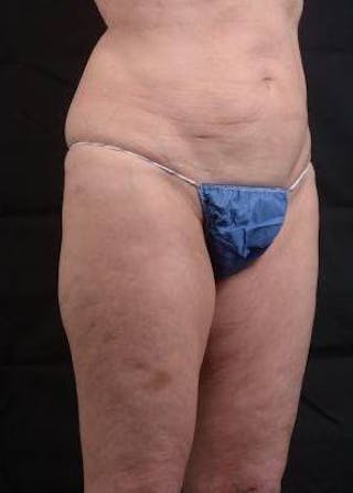 360 Liposuction Before & After Gallery - Patient 225333 - Image 10
