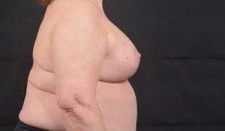 Immediate Breast Reconstruction – Skin Sparing Before & After Gallery - Patient 381662 - Image 6