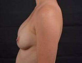 Aesthetic Breast Revision Before & After Gallery - Patient 135077 - Image 4