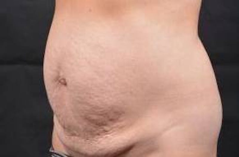 Abdominoplasty Before & After Gallery - Patient 196513 - Image 7