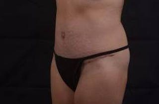Abdominoplasty Before & After Gallery - Patient 196513 - Image 8