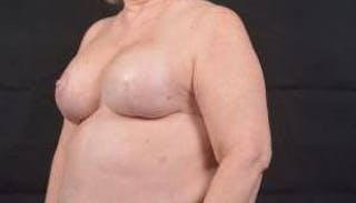 Immediate Breast Reconstruction – Skin Sparing Before & After Gallery - Patient 381662 - Image 8