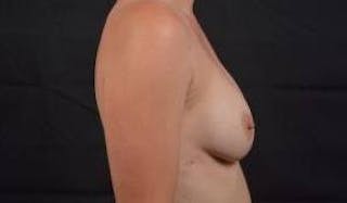 Aesthetic Breast Revision Before & After Gallery - Patient 135077 - Image 6