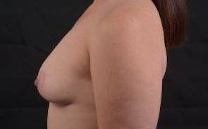Breast Augmentation Silicone Gel Before & After Gallery - Patient 359324 - Image 3