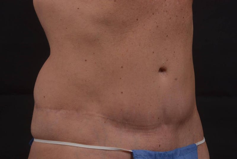 Mommy Makeover Before & After Gallery - Patient 123585 - Image 7