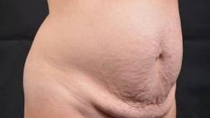 Abdominoplasty Before & After Gallery - Patient 196513 - Image 9