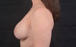 Breast Augmentation Silicone Gel Before & After Gallery - Patient 359324 - Image 4