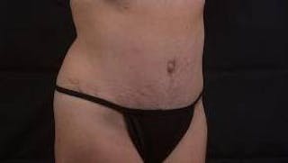 Abdominoplasty Before & After Gallery - Patient 196513 - Image 10
