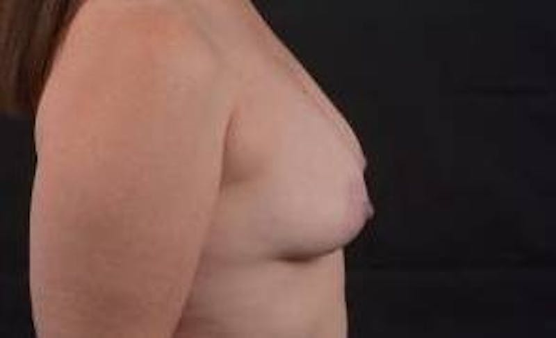 Breast Augmentation Silicone Gel Before & After Gallery - Patient 359324 - Image 5