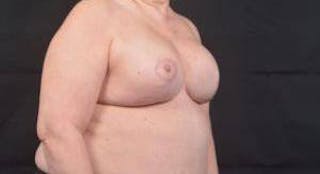 Immediate Breast Reconstruction – Skin Sparing Before & After Gallery - Patient 381662 - Image 10