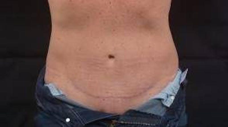 Mommy Makeover Before & After Gallery - Patient 123585 - Image 10