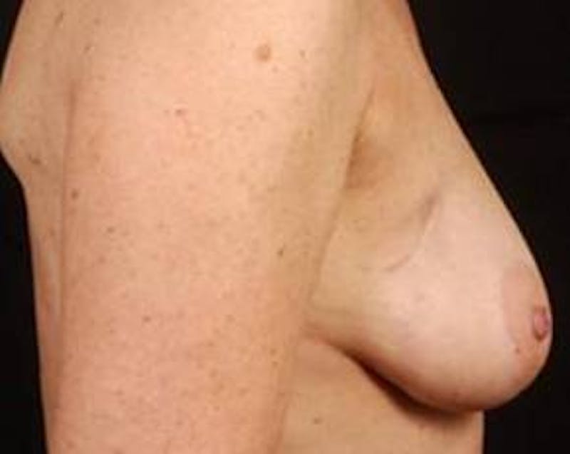 Immediate Breast Reconstruction – Skin Sparing Before & After Gallery - Patient 120845 - Image 3