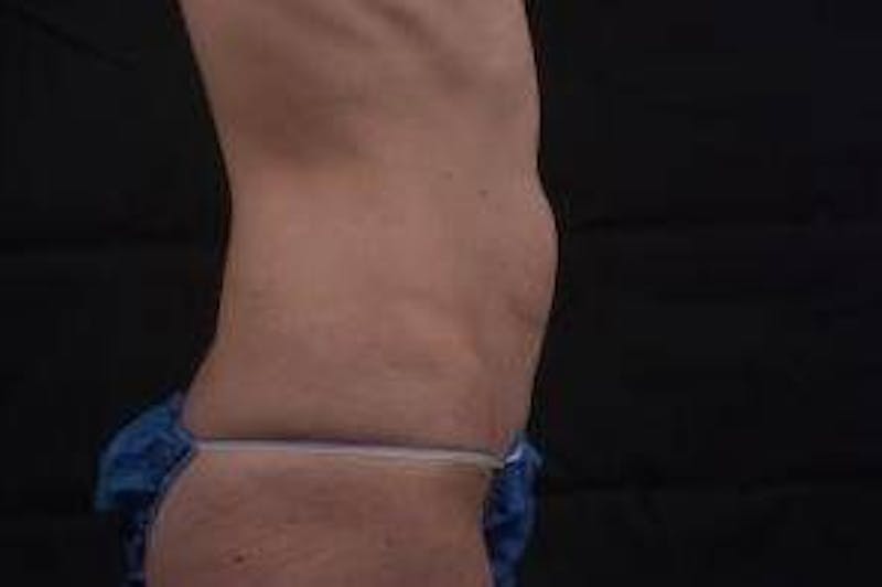 Mommy Makeover Before & After Gallery - Patient 241711 - Image 5