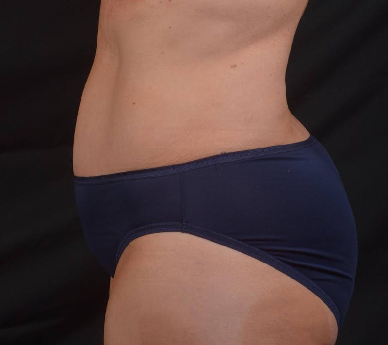 Abdominoplasty Before & After Gallery - Patient 315949 - Image 4
