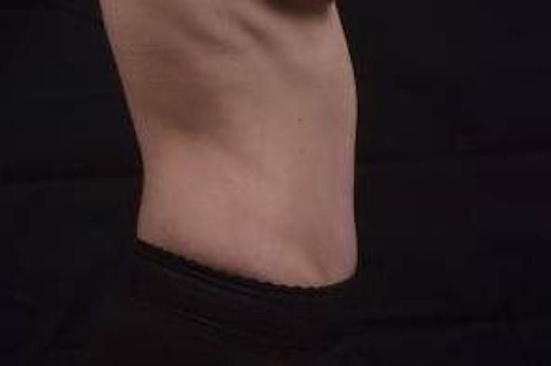 Mommy Makeover Before & After Gallery - Patient 241711 - Image 6