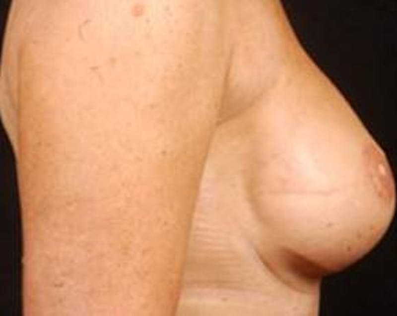 Immediate Breast Reconstruction – Skin Sparing Before & After Gallery - Patient 120845 - Image 4