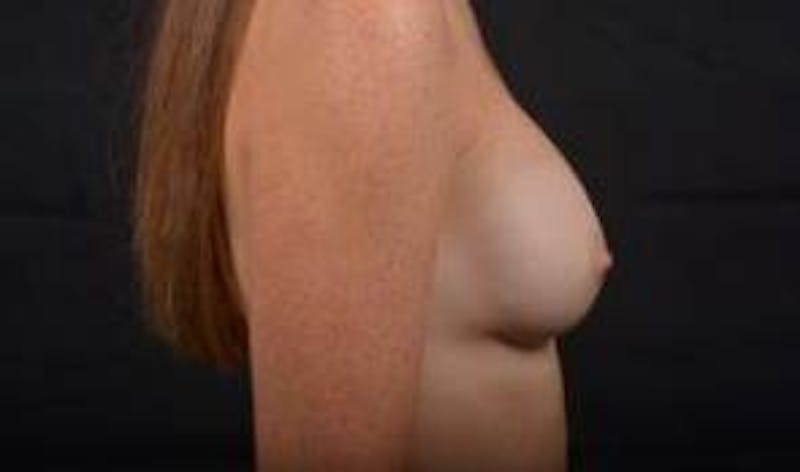 Aesthetic Breast Revision Before & After Gallery - Patient 328152 - Image 6