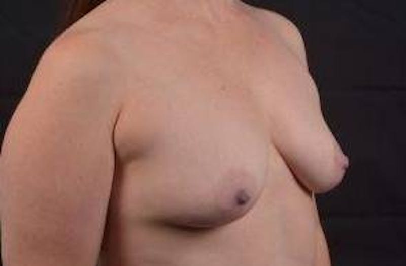 Breast Augmentation Silicone Gel Before & After Gallery - Patient 359324 - Image 9