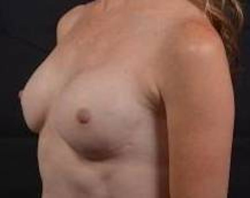 Immediate Breast Reconstruction – Nipple Sparing Before & After Gallery - Patient 618688 - Image 8