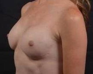 Immediate Breast Reconstruction – Nipple Sparing Before & After Gallery - Patient 618688 - Image 8