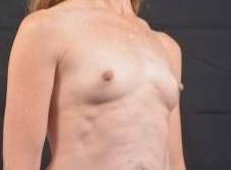 Immediate Breast Reconstruction – Nipple Sparing Before & After Gallery - Patient 618688 - Image 9