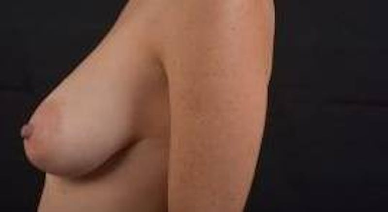 Breast Augmentation Mastopexy Before & After Gallery - Patient 371962 - Image 3
