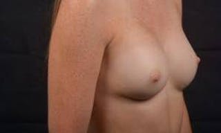 Aesthetic Breast Revision Before & After Gallery - Patient 328152 - Image 10