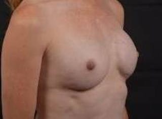 Immediate Breast Reconstruction – Nipple Sparing Before & After Gallery - Patient 618688 - Image 10