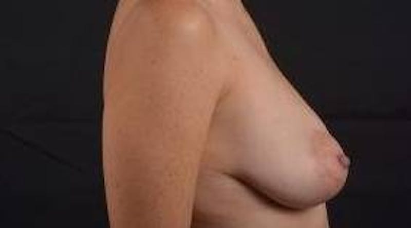 Breast Augmentation Mastopexy Before & After Gallery - Patient 371962 - Image 5