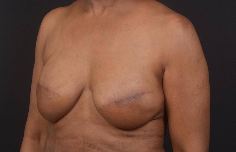 Immediate Breast Reconstruction – Skin Sparing Before & After Gallery - Patient 273184 - Image 8
