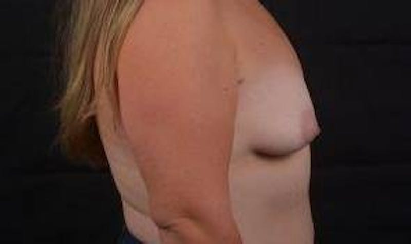 Breast Augmentation Silicone Gel Before & After Gallery - Patient 111835 - Image 5