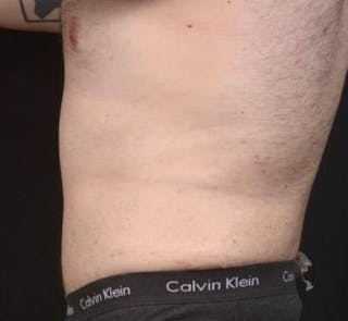 Abdominoplasty Before & After Gallery - Patient 384285 - Image 4