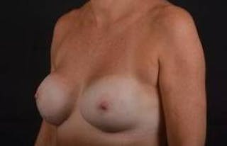 Immediate Breast Reconstruction – Nipple Sparing Before & After Gallery - Patient 290695 - Image 8