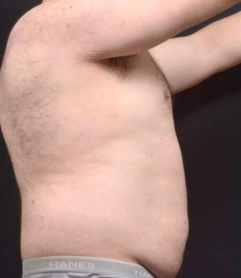 Abdominoplasty Before & After Gallery - Patient 384285 - Image 5