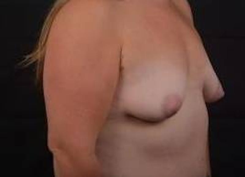 Breast Augmentation Silicone Gel Before & After Gallery - Patient 111835 - Image 9