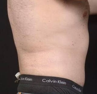 Abdominoplasty Before & After Gallery - Patient 384285 - Image 6