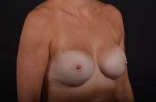Immediate Breast Reconstruction – Nipple Sparing Before & After Gallery - Patient 290695 - Image 10