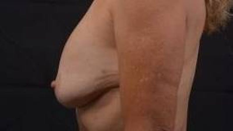 Breast Augmentation Mastopexy Before & After Gallery - Patient 355673 - Image 3