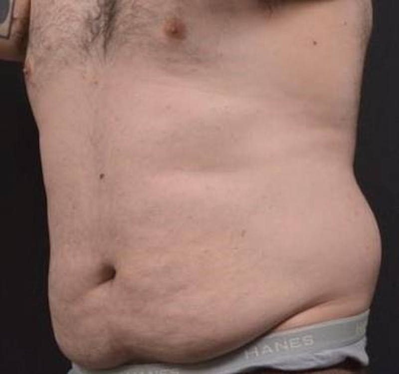 Abdominoplasty Before & After Gallery - Patient 384285 - Image 7