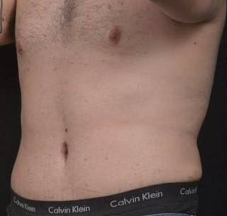 Abdominoplasty Before & After Gallery - Patient 384285 - Image 8