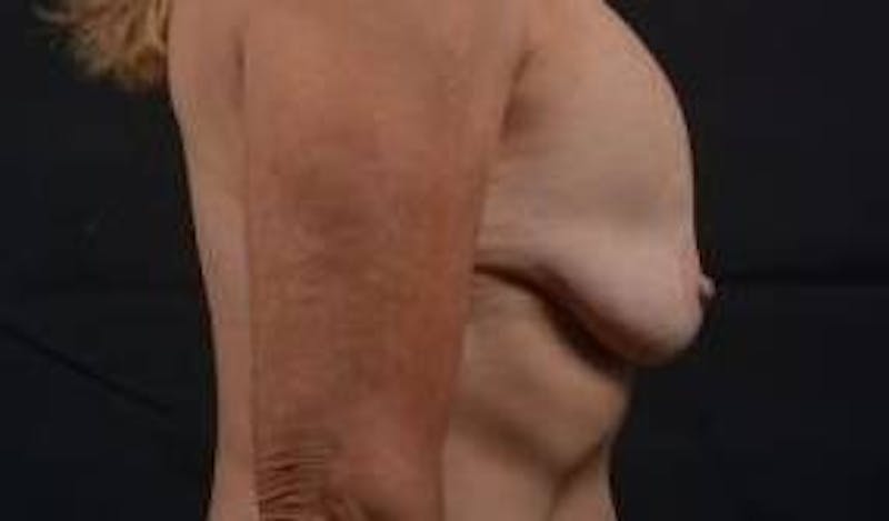 Breast Augmentation Mastopexy Before & After Gallery - Patient 355673 - Image 5