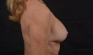 Breast Augmentation Mastopexy Before & After Gallery - Patient 355673 - Image 6