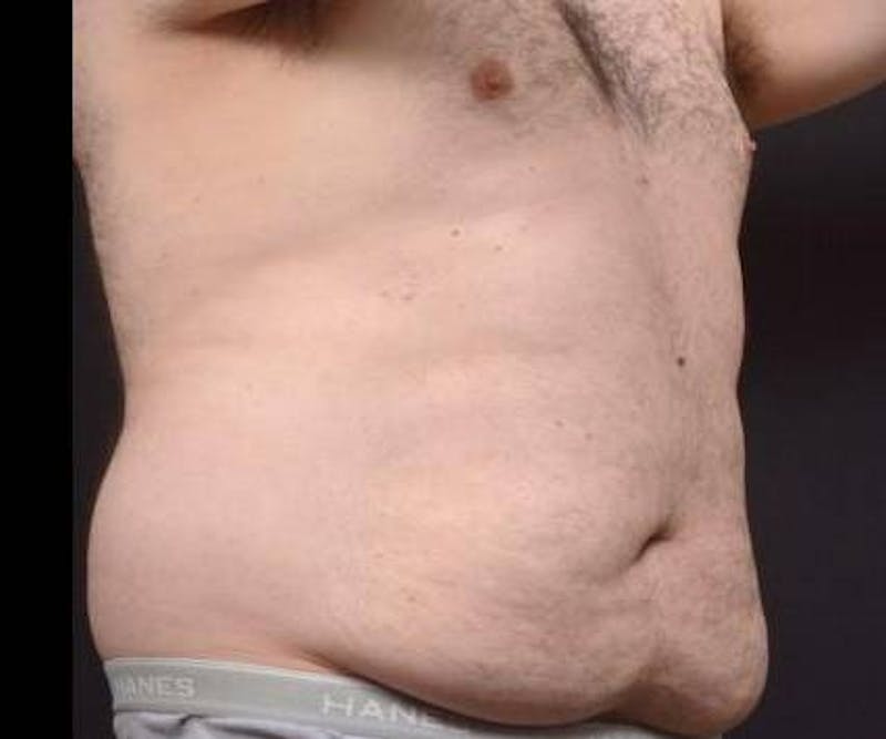 Abdominoplasty Before & After Gallery - Patient 384285 - Image 9