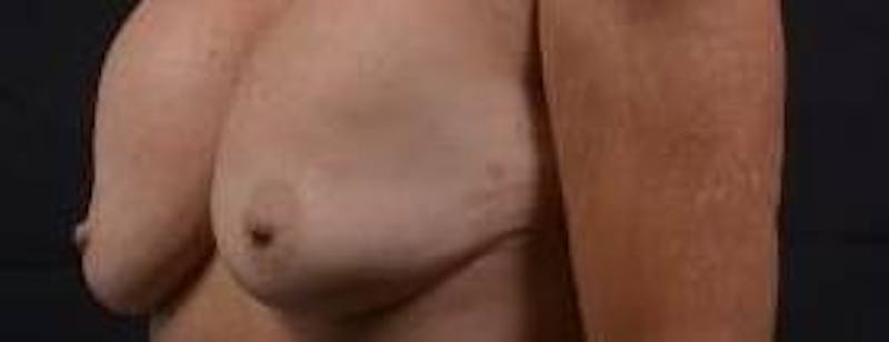 Breast Augmentation Mastopexy Before & After Gallery - Patient 355673 - Image 7