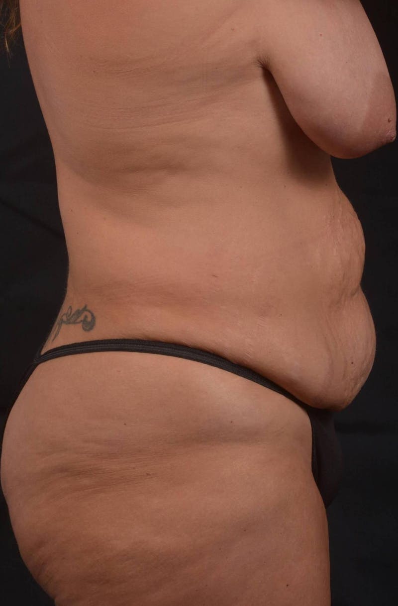 Mommy Makeover Before & After Gallery - Patient 884053 - Image 5