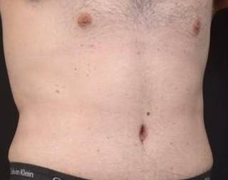 Abdominoplasty Before & After Gallery - Patient 384285 - Image 10
