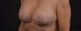 Breast Augmentation Mastopexy Before & After Gallery - Patient 355673 - Image 8